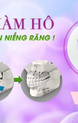 Phẫu thuật hàm hô móm